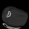 SPORK, NICO - 22.03.1976 - 02.08.2022 - CT obere Extremität - 17:59:38